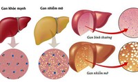 Hình ảnh minh họa gan nhiễm mỡ. 