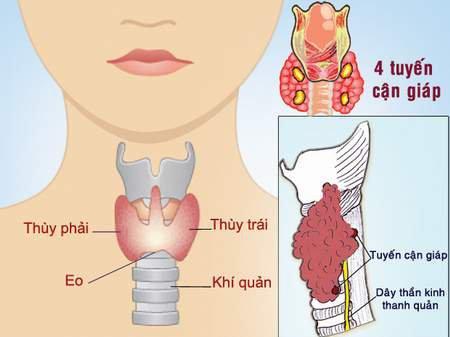 Thực phẩm bổ sung i ốt có gây bướu cổ, ung thư tuyến giáp?- Ảnh 2.