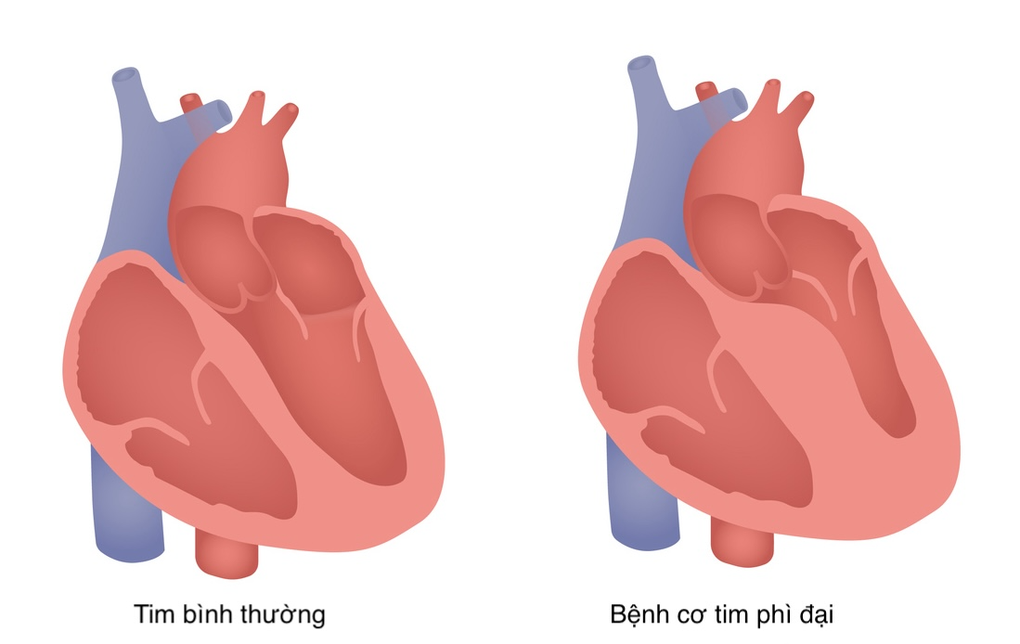 Bơm cồn sinh học cứu sống bệnh nhân bị bệnh cơ tim phì đại nặng - 2