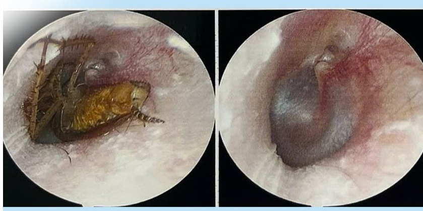 Suýt bị điếc do con gián chui vào tai khi đang ngủ- Ảnh 1.