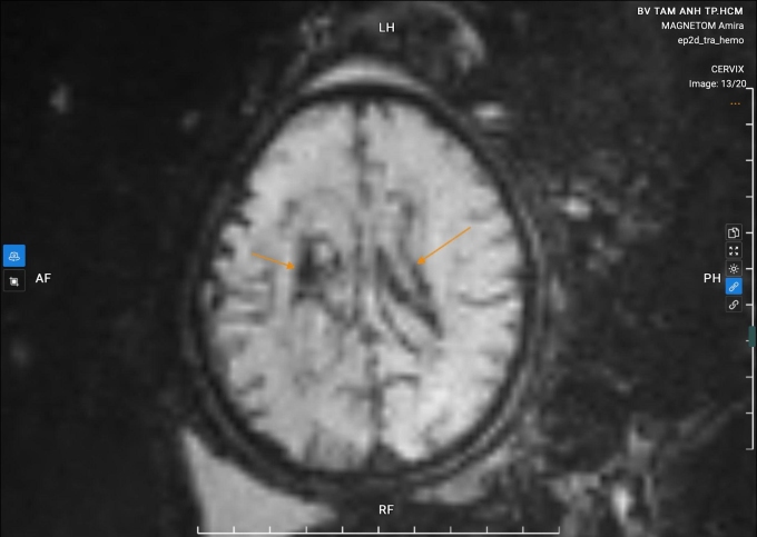 Hình chụp MRI cho thấy xuất huyết lan vào nhu mô não của thai nhi. Ảnh: Bệnh viện Đa khoa Tâm Anh