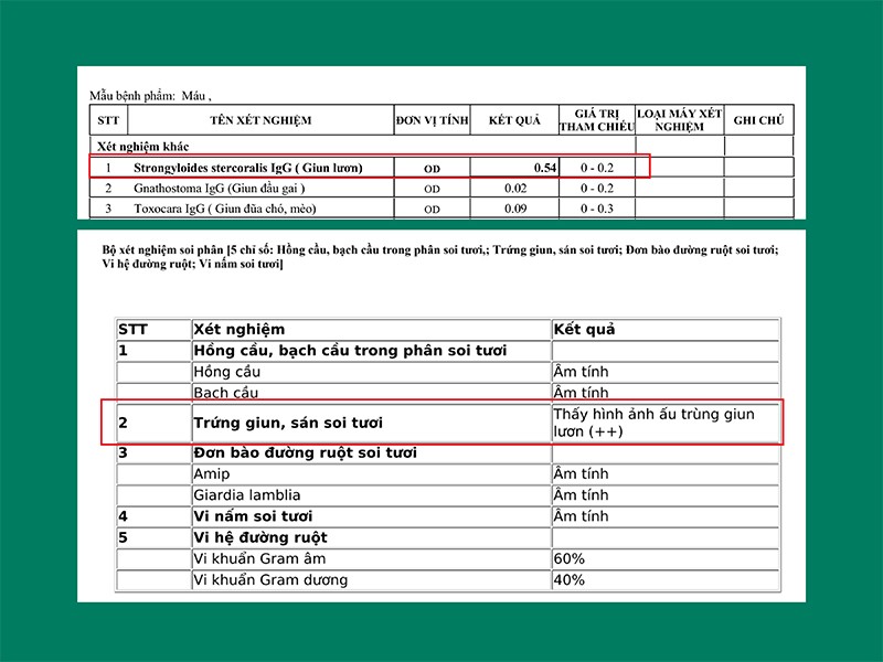 Kết quả xét nghiệm máu và phân của bệnh nhân T dương tính với ký sinh trùng giun lươn