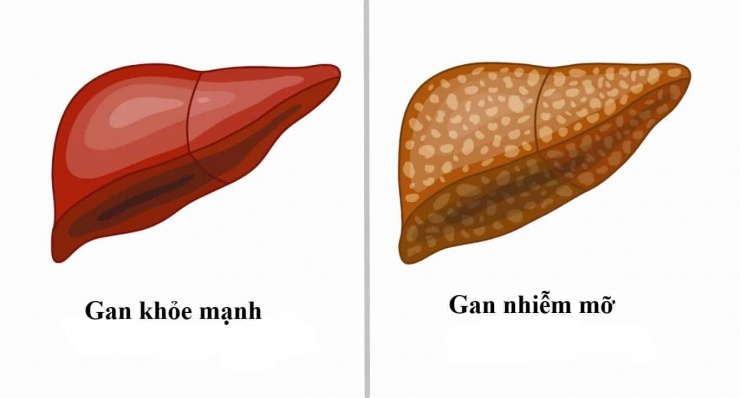 4 dấu hiệu cảnh báo mắc bệnh gan nhiễm mỡ dễ nhận biết - 1