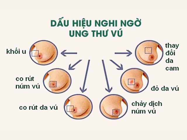 Hướng dẫn tự khám vú định kỳ tại nhà. Nguồn: Bệnh viện K.