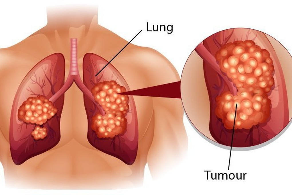 Ung thư phổi đứng đầu về tỷ lệ tử vong: Làm gì để phát hiện sớm? - 2