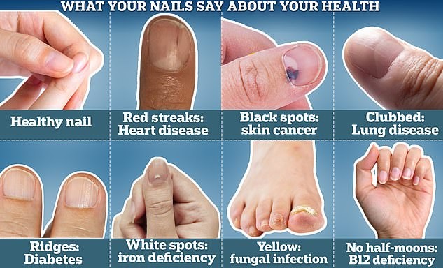 Nhận biết dấu hiệu bệnh qua móng tay. Ảnh: Dailymail