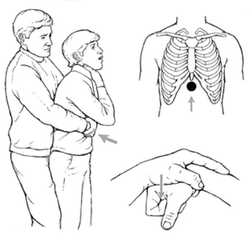 Mẹ nghẹt thở do hóc quả nho và phản ứng bất ngờ của cậu con trai 10 tuổi - 2