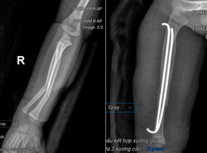 Phim chụp X-quang tình trạng cẳng tay phải của bệnh nhi trước (trái) và sau phẫu thuật. Ảnh: Bệnh viện cung cấp