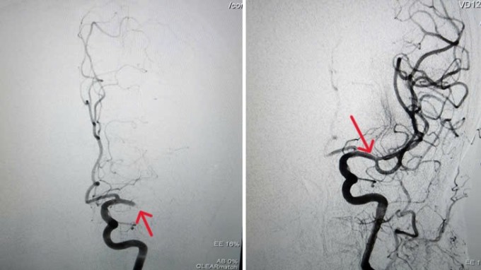 Động mạch não giữa bên trái của cụ Năm bị tắc hoàn toàn (hình trái) và tái thông sau khi can thiệp nội mạch (hình phải). Ảnh: Bệnh viện cung cấp