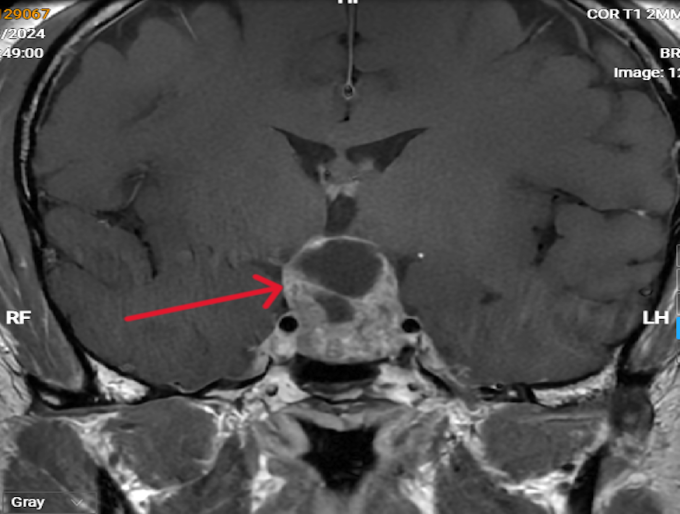 Khối u tuyến yên đã xuất huyết của anh Phong trên hình chụp MRI 3 Tesla. Ảnh: Phòng khám Đa khoa Tâm Anh