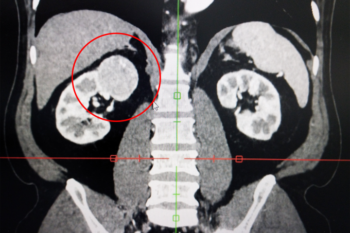 Ảnh chụp CT cho thấy khối u thận phải (khoanh đỏ) của ông Dũng nằm ở vị trí phức tạp, gần nhiều cơ quan xung quanh. Ảnh: Bệnh viện Đa khoa Tâm Anh