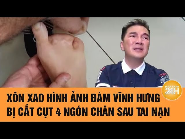 Ca sĩ Đàm Vĩnh Hưng phải cắt cụt 4 ngón chân là thật  - Ảnh 2.