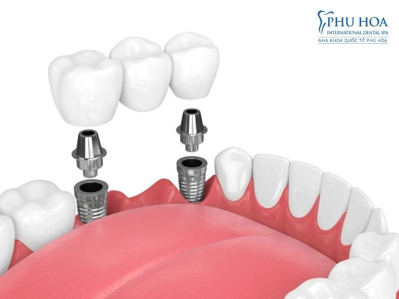 Công nghệ trồng răng implant vượt trội tại Nha khoa Quốc tế Phú Hòa- Ảnh 1.