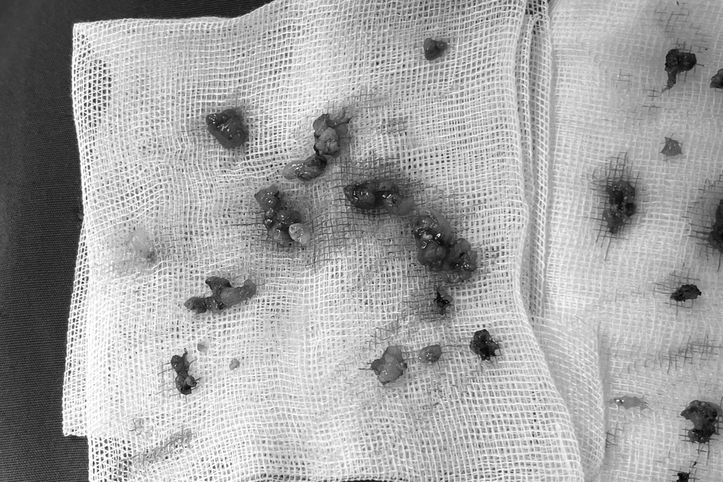 Người phụ nữ ở TPHCM bị biến dạng cơ thể vì tiêm filler collagen giá rẻ - 3