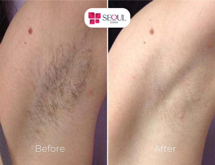 Gợi ý địa chỉ triệt lông hiệu quả - an toàn - uy tín 2 Gợi ý địa chỉ triệt lông hiệu quả - an toàn - uy tín - chất lượng