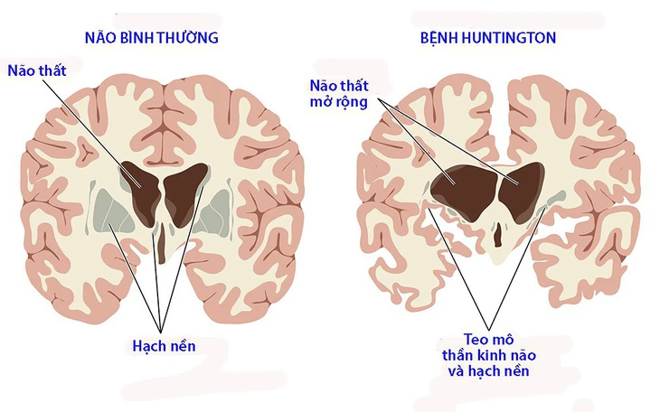 Lần đầu tiên điều trị thành công bệnh di truyền gây tử vong Huntington - Ảnh 3.