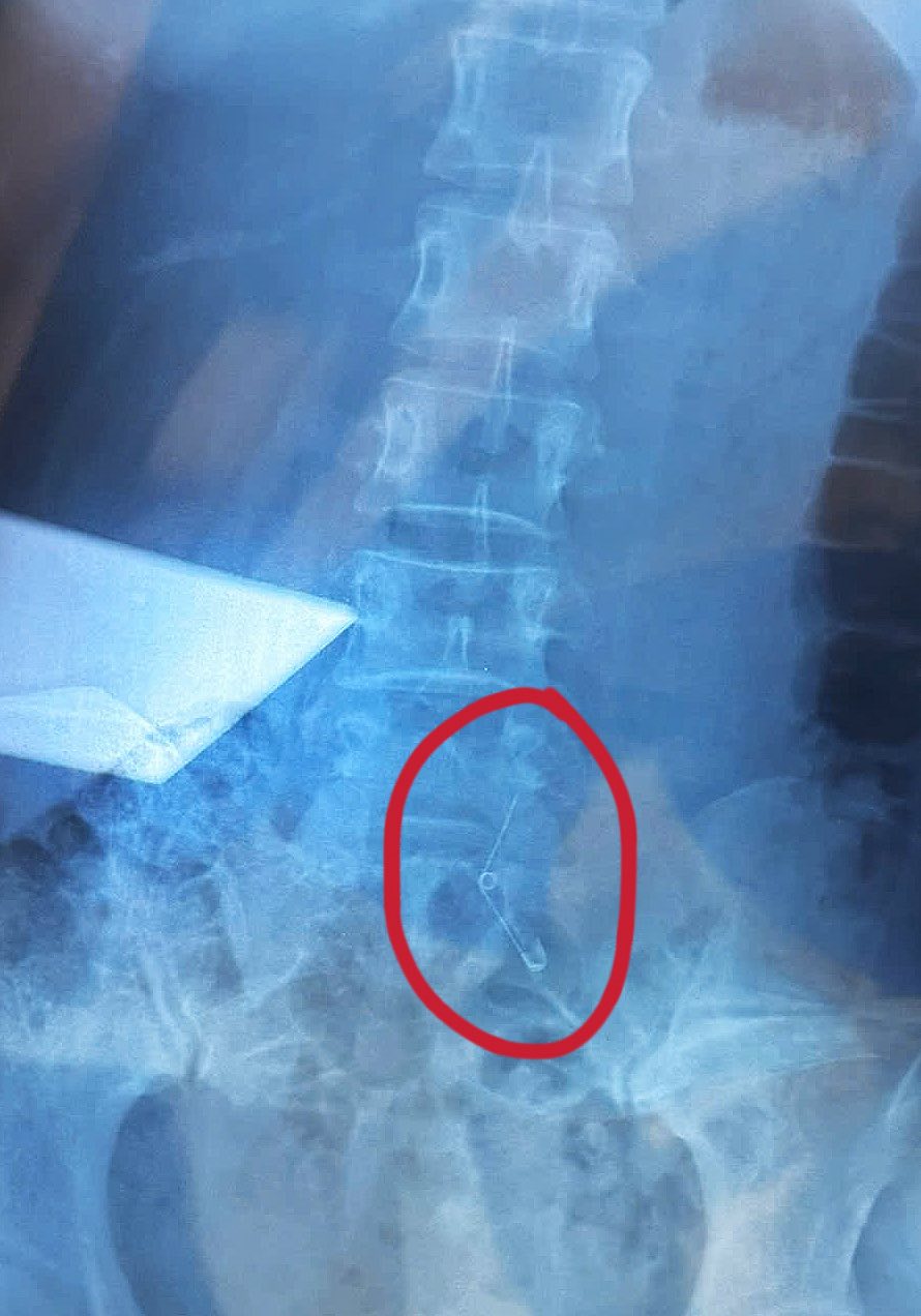 Đi ăn ốc, cô gái nuốt cả chiếc kim băng đang mở vào bụng, phải mổ cấp cứu 6 tiếng, tốn 70 triệu- Ảnh 2.