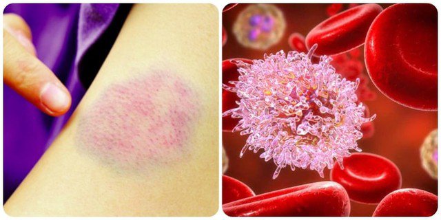 Nam diễn viên 34 tuổi đang khỏe mạnh bất ngờ tiết lộ mắc ung thư máu: Tâm sự đầy xúc động! 4 Ảnh minh họa