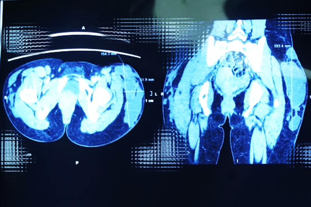 Người phụ nữ ở TPHCM bị biến dạng cơ thể vì tiêm filler collagen giá rẻ - 1