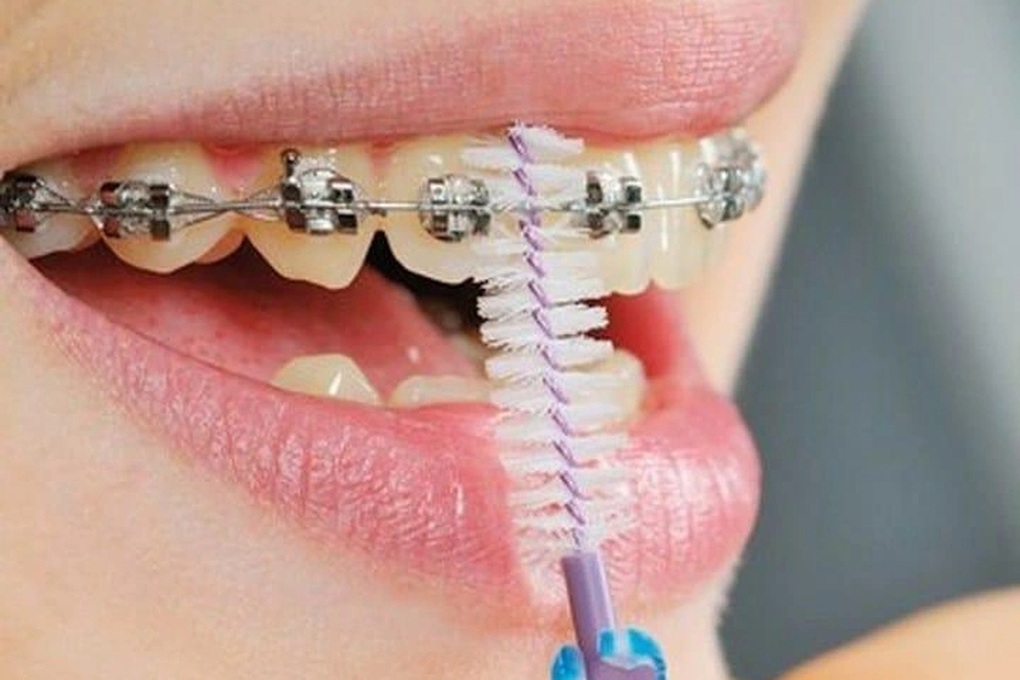 Sai lầm khi niềng răng nhiều người Việt mắc phải - 1