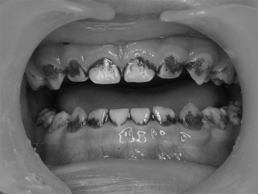 Trẻ có mảng bám đen trên răng sữa có gây mất răng? 1 Trẻ có mảng bám đen trên răng sữa có gây mất răng? - Ảnh 1.