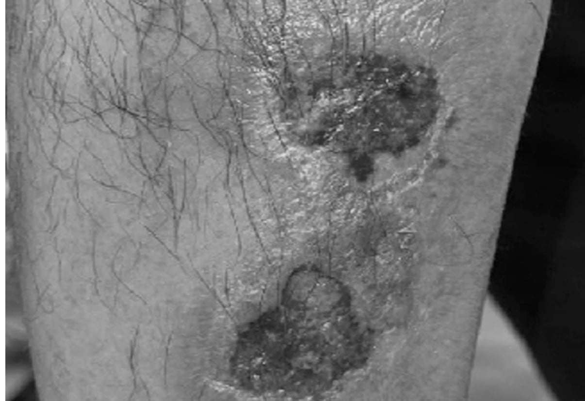 Tự ý điều chỉnh đơn thuốc, người đàn ông 50 tuổi tổn thương nặng ở vùng kín 1 Vết tổn thương của bệnh nhân do sử dụng thuốc sai cách.