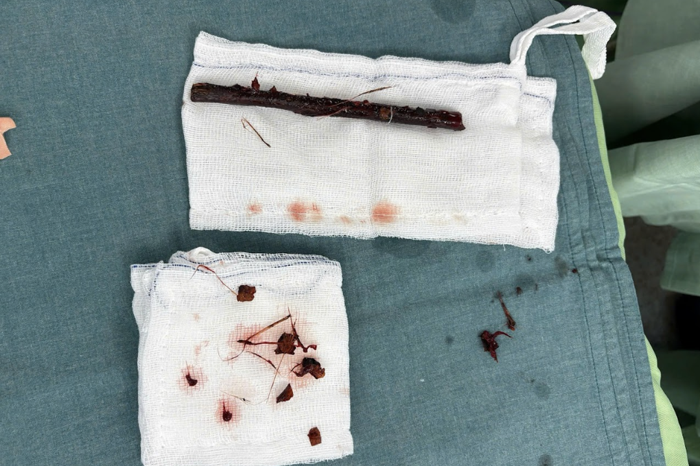 Hy hữu bé gái bị cành cây đâm xuyên hậu môn, nằm trong bụng suốt 4 tháng - 2