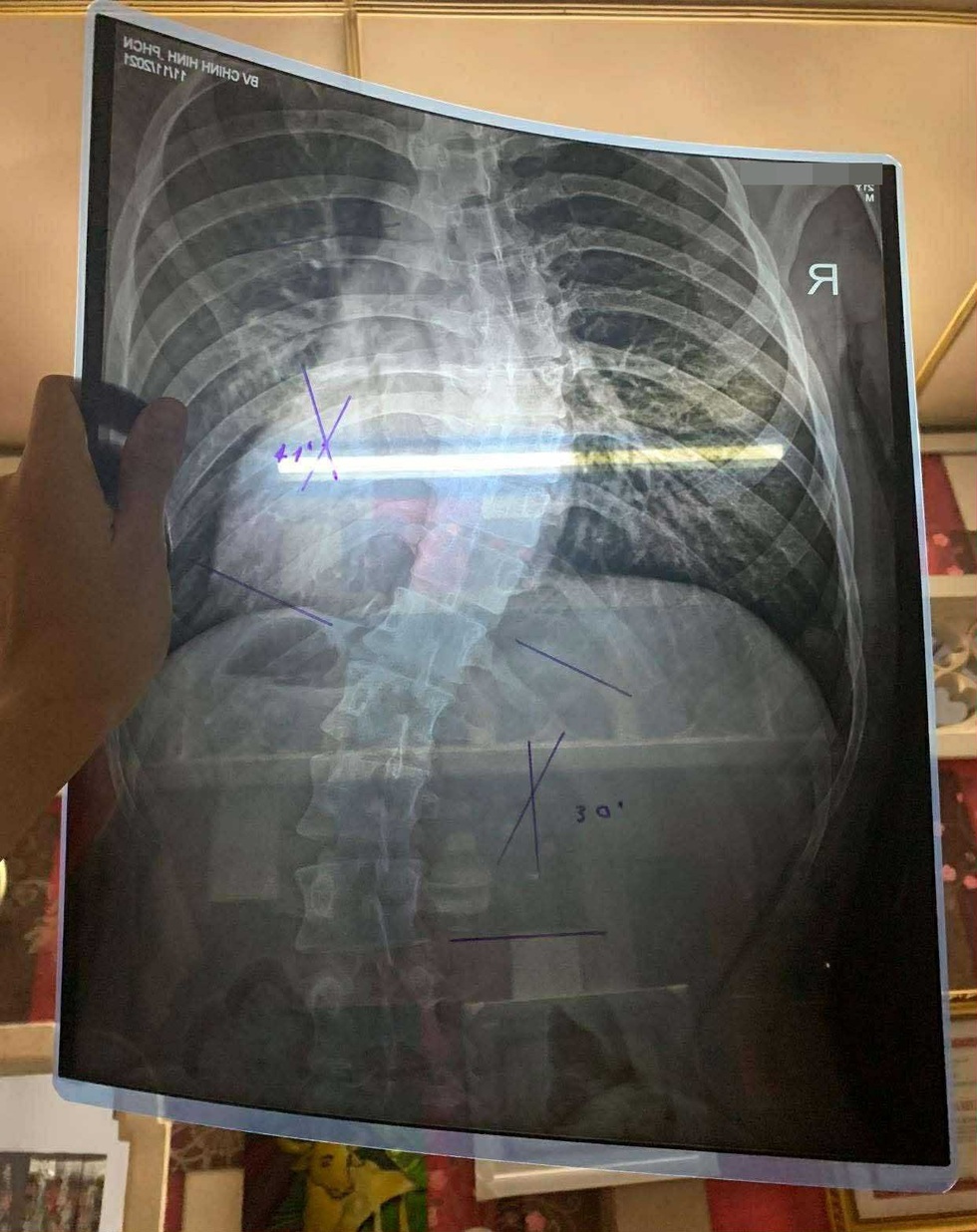 Dân văn phòng vai lệch nặng, cột sống cong vẹo trước tuổi 30 - 2