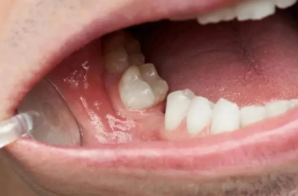 sức khỏe, sức khỏe răng miệng, răng miệng, số răng đạt chuẩn