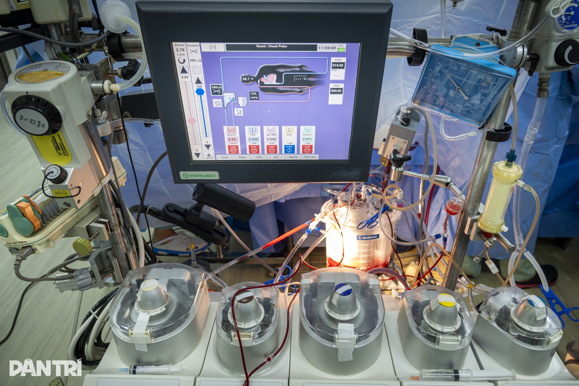 Hồi hộp xem bác sĩ đeo kính 3D xe chỉ, luồn kim cứu trái tim lỗi nhịp - 3 Hồi hộp xem bác sĩ đeo kính 3D xe chỉ, luồn kim cứu trái tim lỗi nhịp - 3