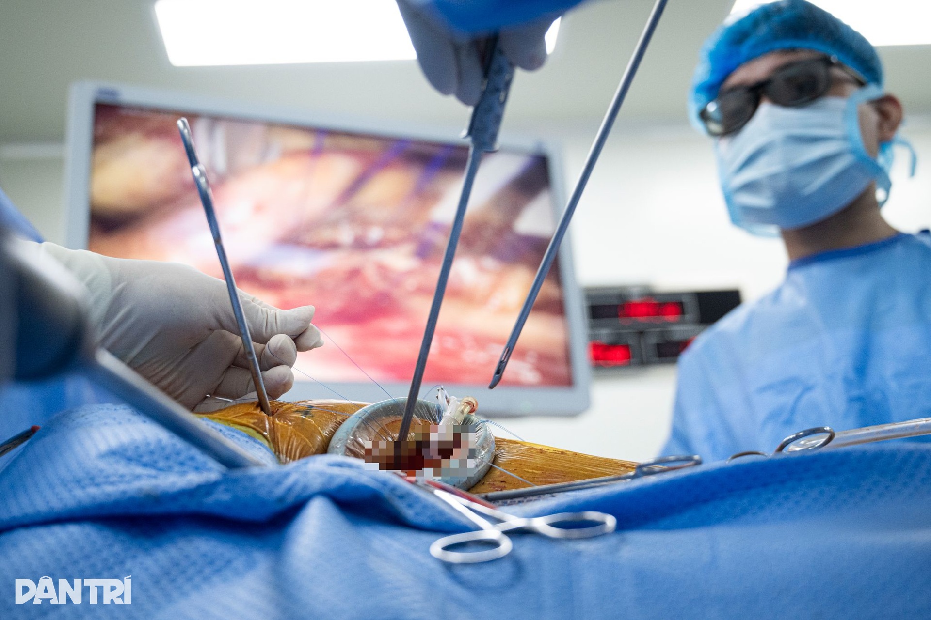 Hồi hộp xem bác sĩ đeo kính 3D xe chỉ, luồn kim cứu trái tim lỗi nhịp - 6 Hồi hộp xem bác sĩ đeo kính 3D xe chỉ, luồn kim cứu trái tim lỗi nhịp - 6