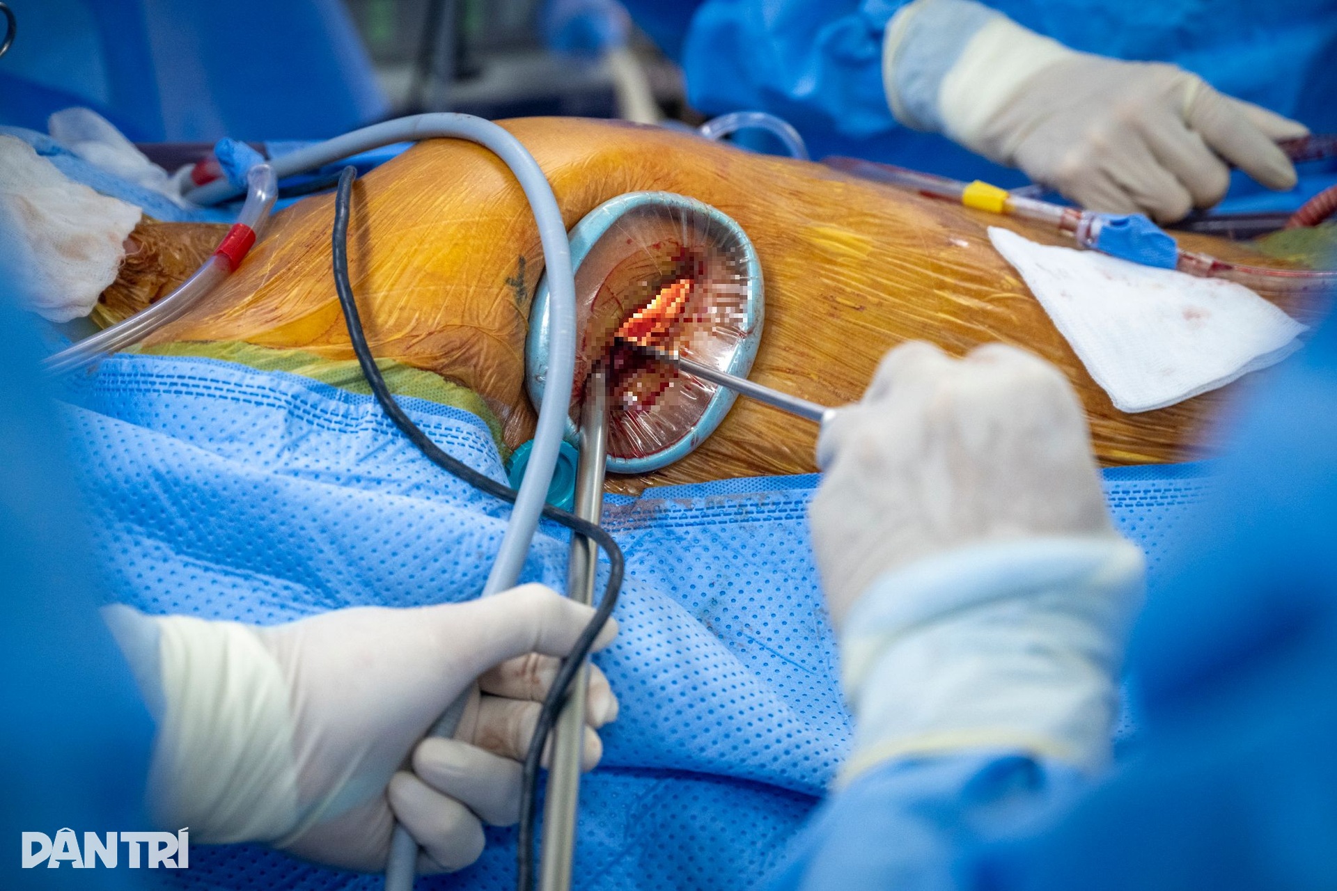 Hồi hộp xem bác sĩ đeo kính 3D xe chỉ, luồn kim cứu trái tim lỗi nhịp - 7 Hồi hộp xem bác sĩ đeo kính 3D xe chỉ, luồn kim cứu trái tim lỗi nhịp - 7