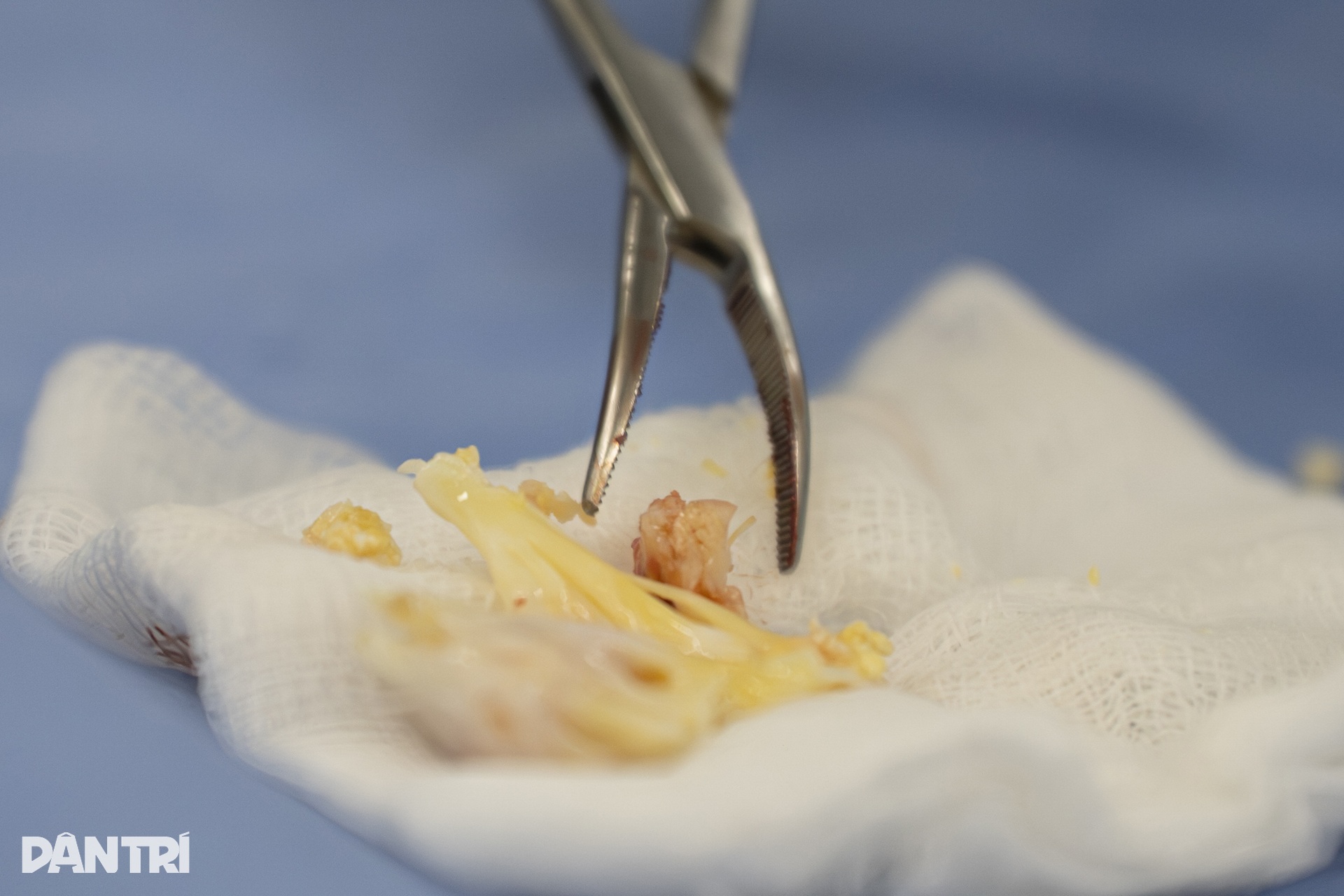 Hồi hộp xem bác sĩ đeo kính 3D xe chỉ, luồn kim cứu trái tim lỗi nhịp - 12 Hồi hộp xem bác sĩ đeo kính 3D xe chỉ, luồn kim cứu trái tim lỗi nhịp - 12