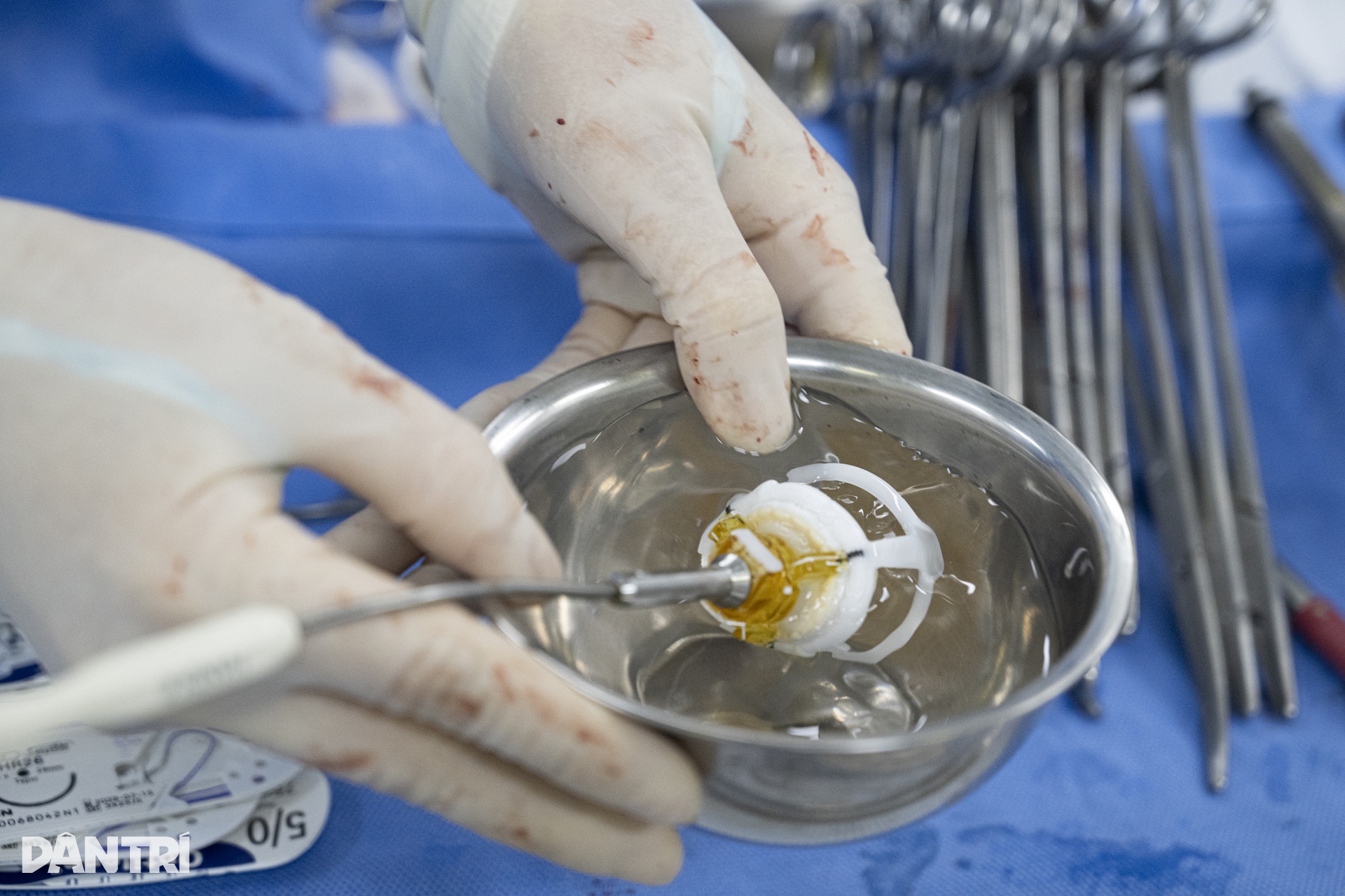 Hồi hộp xem bác sĩ đeo kính 3D xe chỉ, luồn kim cứu trái tim lỗi nhịp - 14 Hồi hộp xem bác sĩ đeo kính 3D xe chỉ, luồn kim cứu trái tim lỗi nhịp - 14