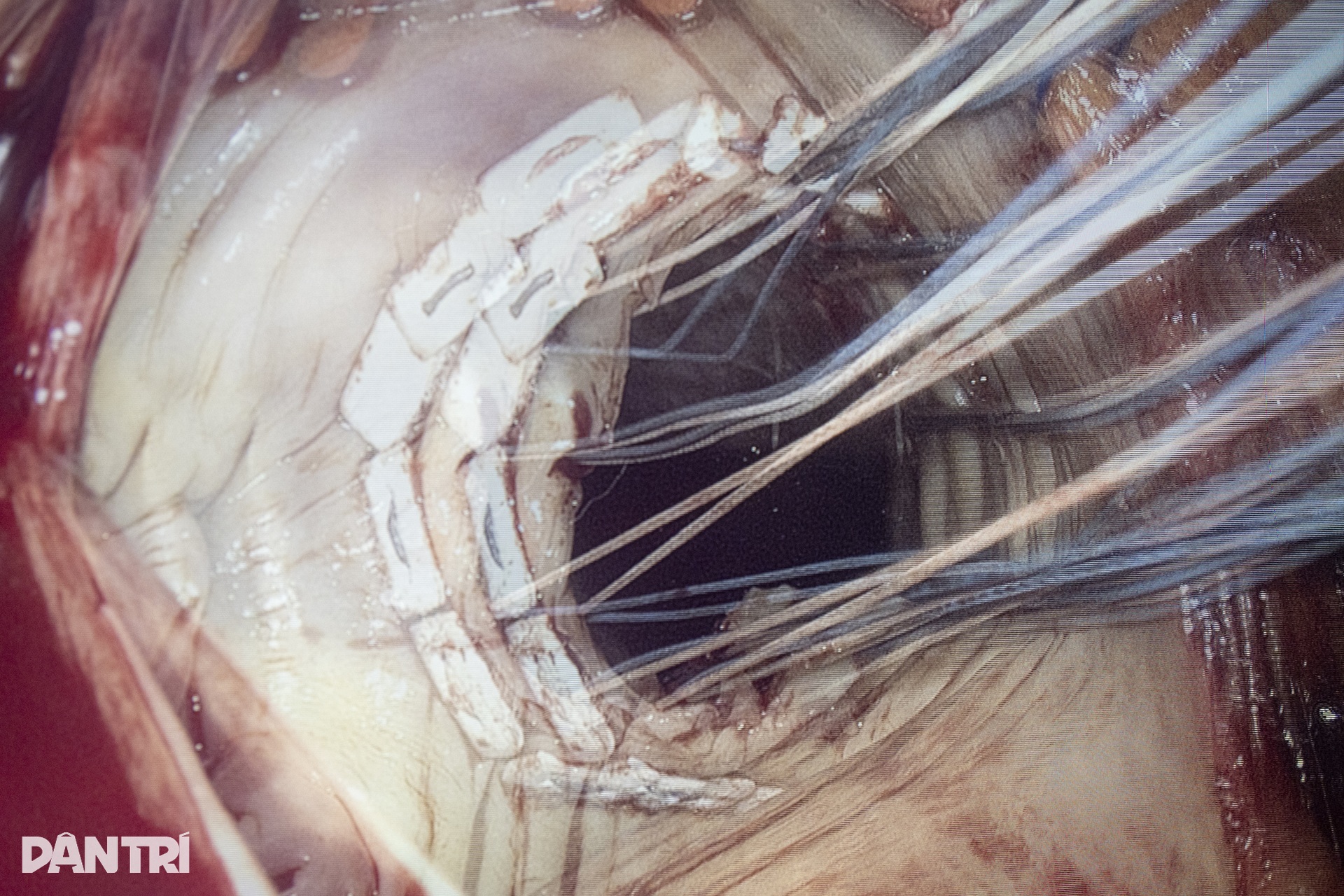 Hồi hộp xem bác sĩ đeo kính 3D xe chỉ, luồn kim cứu trái tim lỗi nhịp - 15 Hồi hộp xem bác sĩ đeo kính 3D xe chỉ, luồn kim cứu trái tim lỗi nhịp - 15