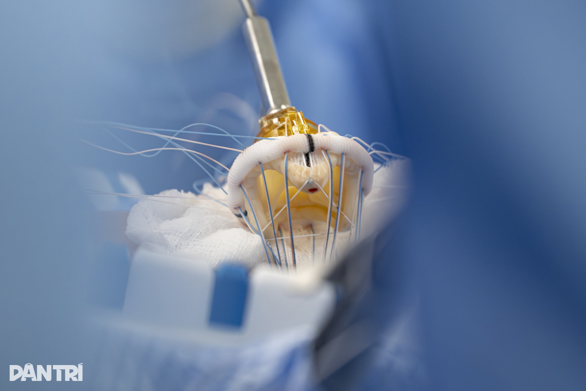 Hồi hộp xem bác sĩ đeo kính 3D xe chỉ, luồn kim cứu trái tim lỗi nhịp - 17 Hồi hộp xem bác sĩ đeo kính 3D xe chỉ, luồn kim cứu trái tim lỗi nhịp - 17