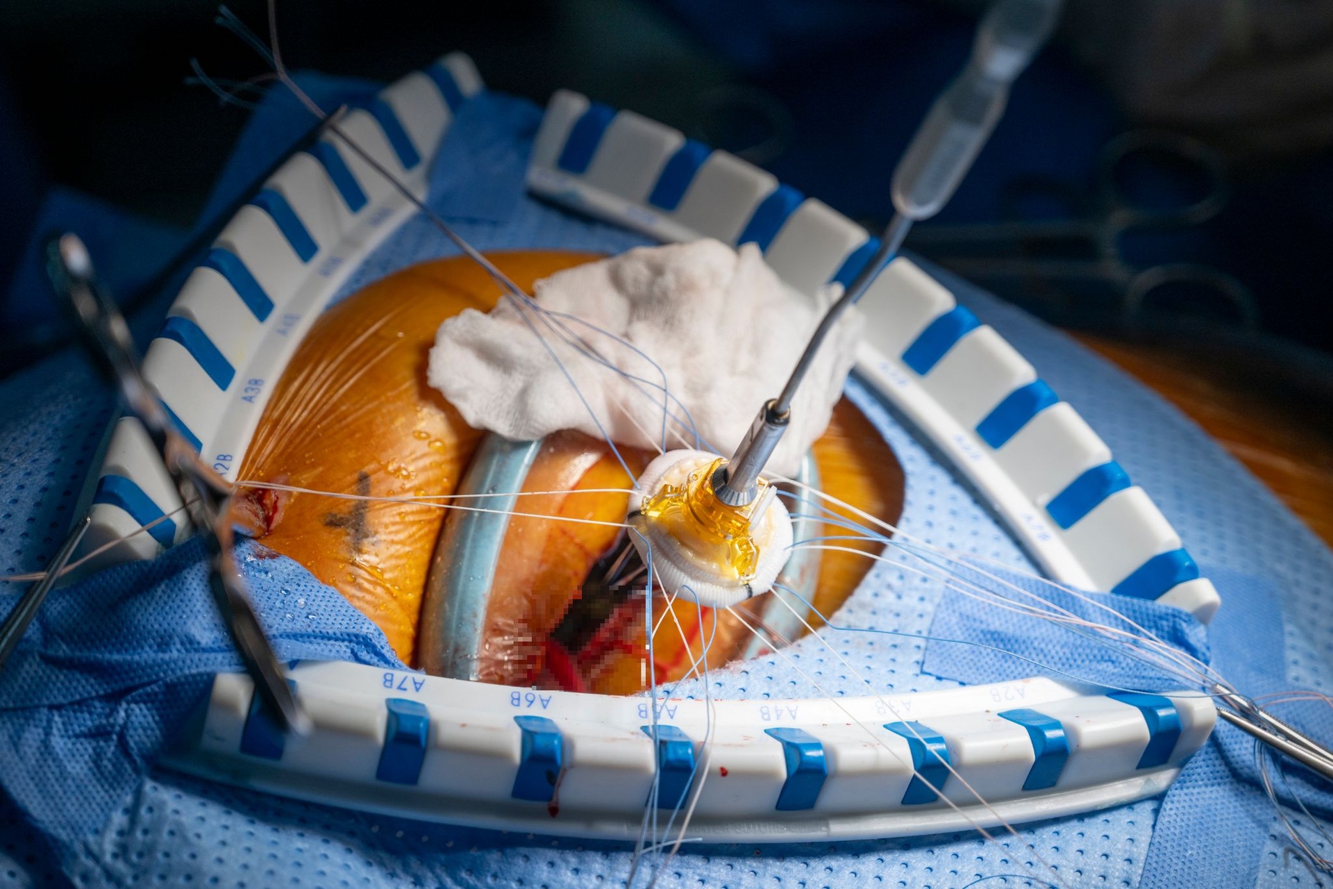 Hồi hộp xem bác sĩ đeo kính 3D xe chỉ, luồn kim cứu trái tim lỗi nhịp - 16 Hồi hộp xem bác sĩ đeo kính 3D xe chỉ, luồn kim cứu trái tim lỗi nhịp - 16