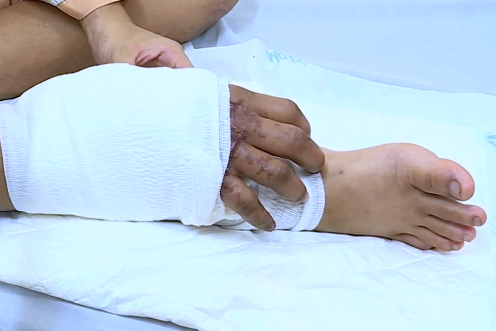 Thông tin mới nhất về cô gái mang thai được ghép tạm tay đứt lìa vào chân - 2