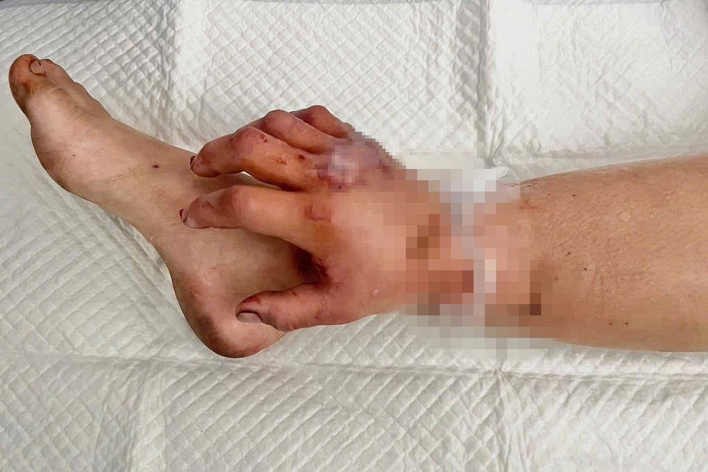 Vì sao bác sĩ phải ghép tạm tay đứt lìa vào chân cô gái mang song thai? - 3