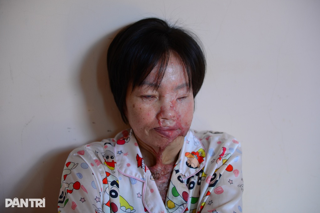 Bạn đọc hỗ trợ người phụ nữ bị bỏng axit ở Lâm Đồng 176 triệu đồng - 2