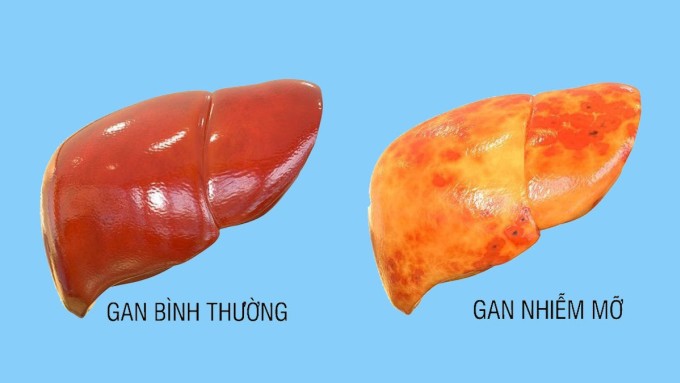 Thoát khỏi gan nhiễm mỡ nặng sau nửa năm nhờ 3 thay đổi - 2