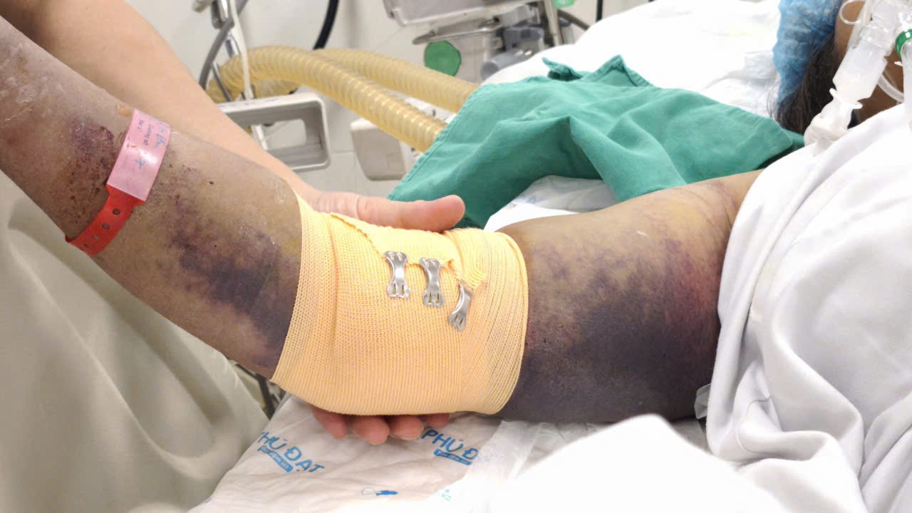 Nhiều người nguy kịch vì sốt xuất huyết 3 Một bệnh nhân nặng do sốt xuất huyết.