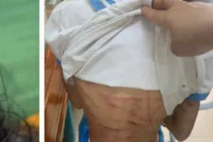 Công an vào cuộc vụ bé gái lớp 5 nghi bị cha dượng bạo hành