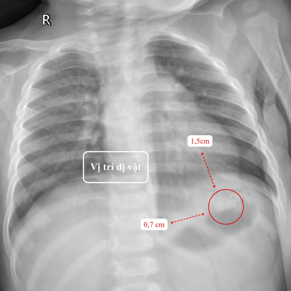 Bé 10 tháng suýt thủng ruột vì nuốt điếu thuốc lá chứa mảnh kim loại - 2