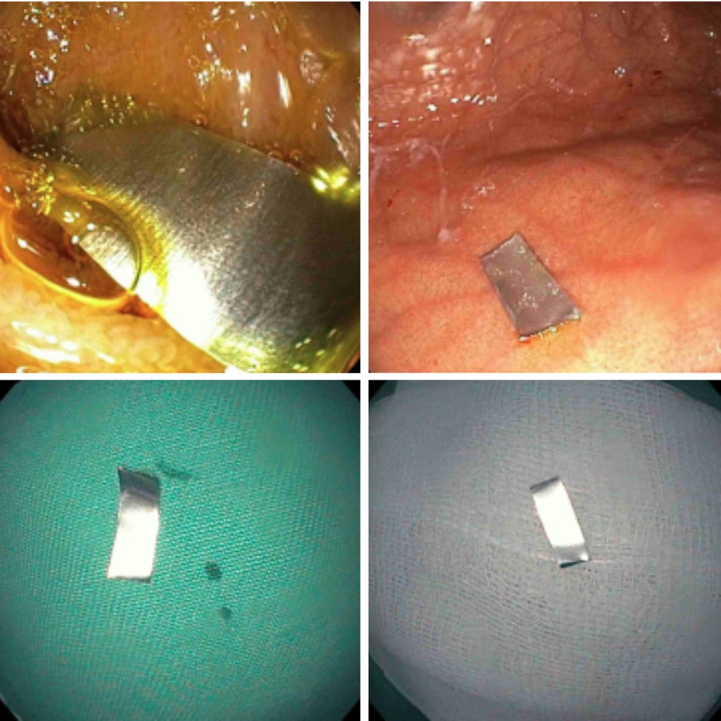 Bé 10 tháng suýt thủng ruột vì nuốt điếu thuốc lá chứa mảnh kim loại - 3