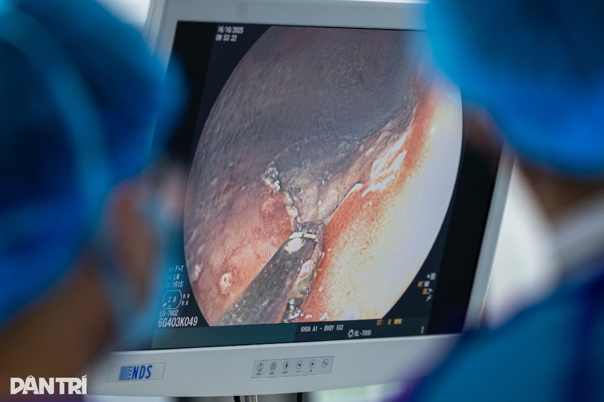 Xem bác sĩ thâm nhập dạ dày truy vết ung thư - 8