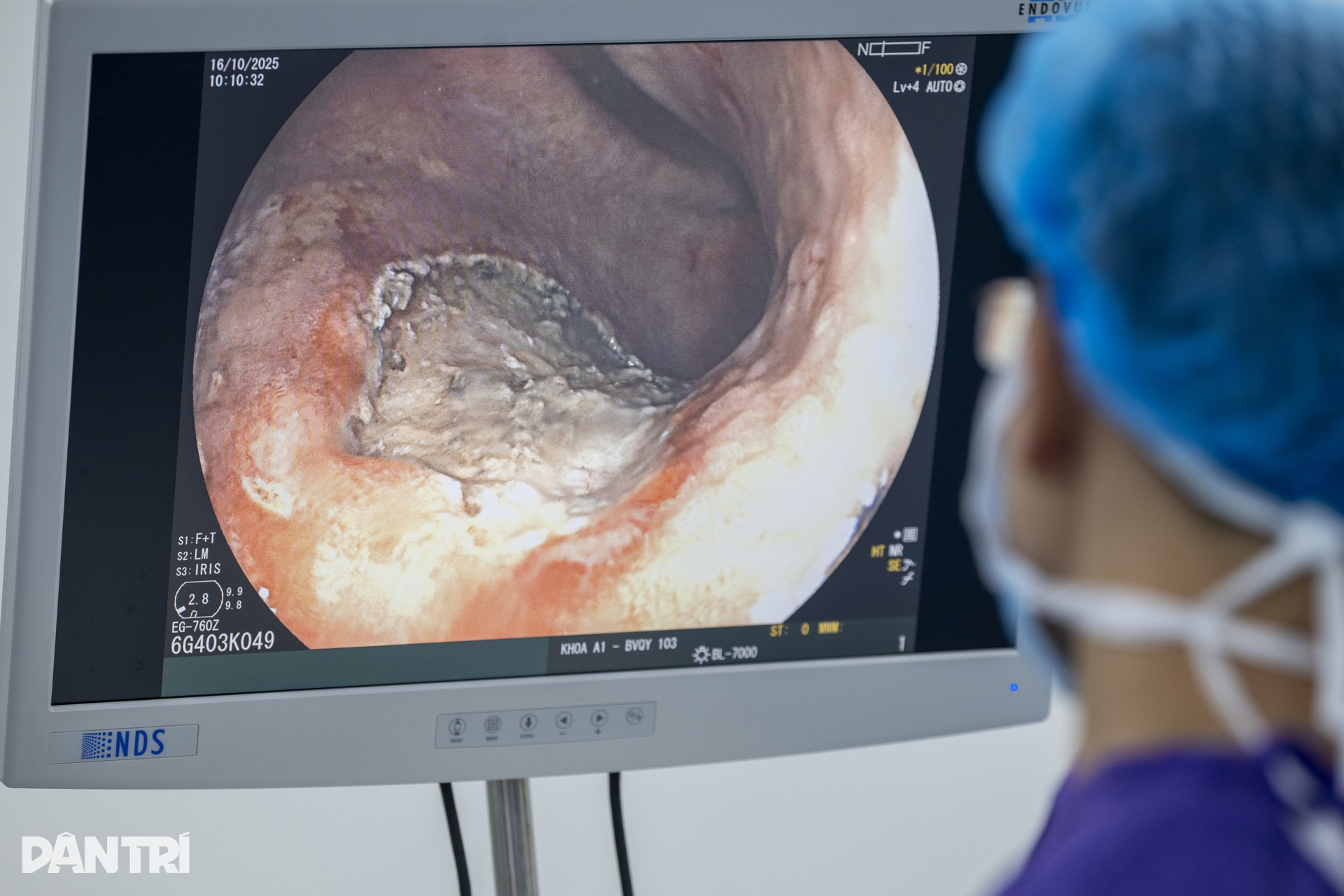 Xem bác sĩ thâm nhập dạ dày truy vết ung thư - 9