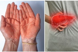 Những dấu hiệu ở tay cảnh báo gan đang "kêu cứu"