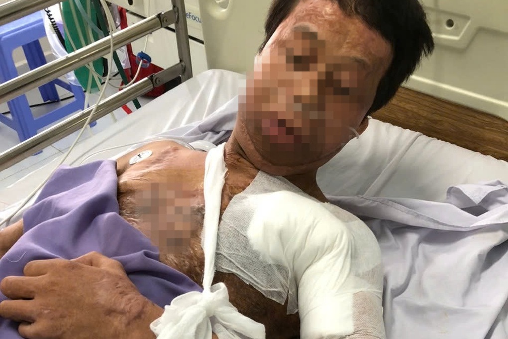 Chàng trai hóa “ngọn đuốc sống” vì hút thuốc khi đổ xăng, đi mổ hơn 20 lần - 2