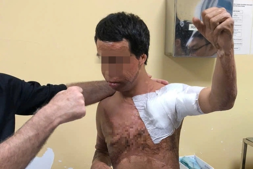 Chàng trai hóa “ngọn đuốc sống” vì hút thuốc khi đổ xăng, đi mổ hơn 20 lần - 3